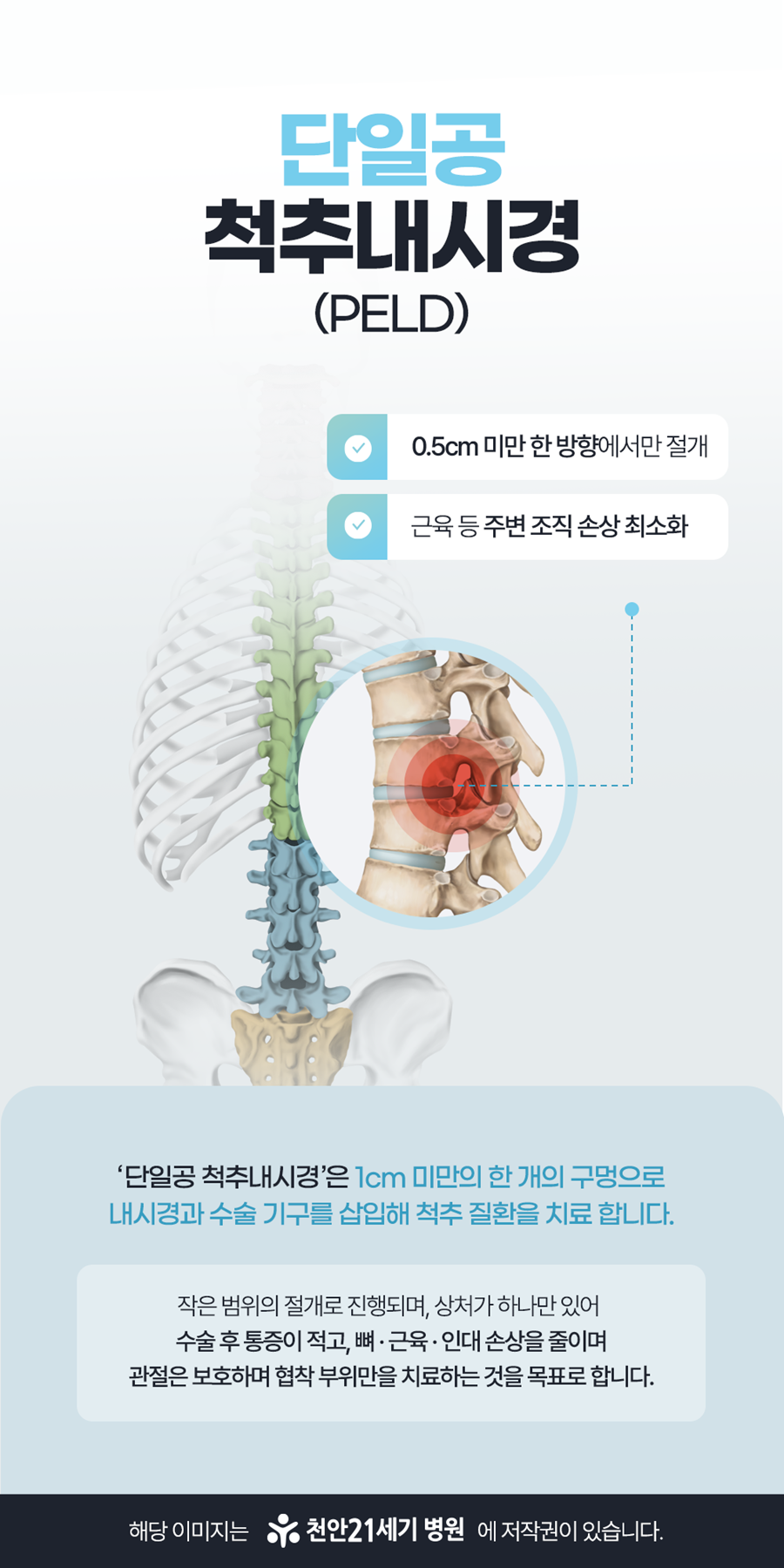천안21세기병원 단일공 척추내시경