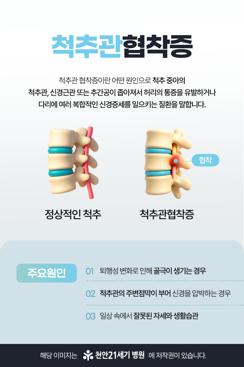 천안21세기병원 척추관협착증